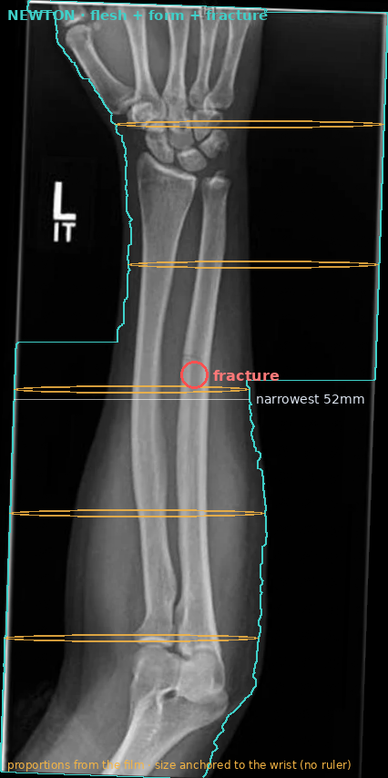 Newton's read: flesh silhouette traced, cross-section contour, and the fracture flagged on the real film